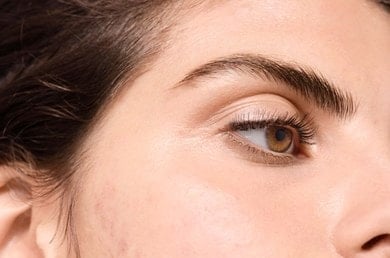 Vichy πρόσωπο με ακμή