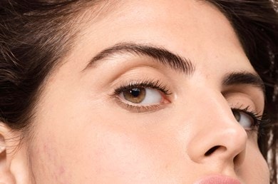 ορμονική ακμή