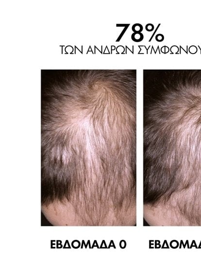 SCALP LINE