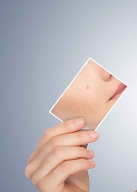 Τι είναι η κυστική ακμή και πώς να την αντιμετωπίσετε