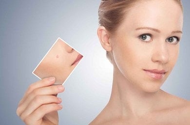 Τι είναι η κυστική ακμή και πώς να την αντιμετωπίσετε