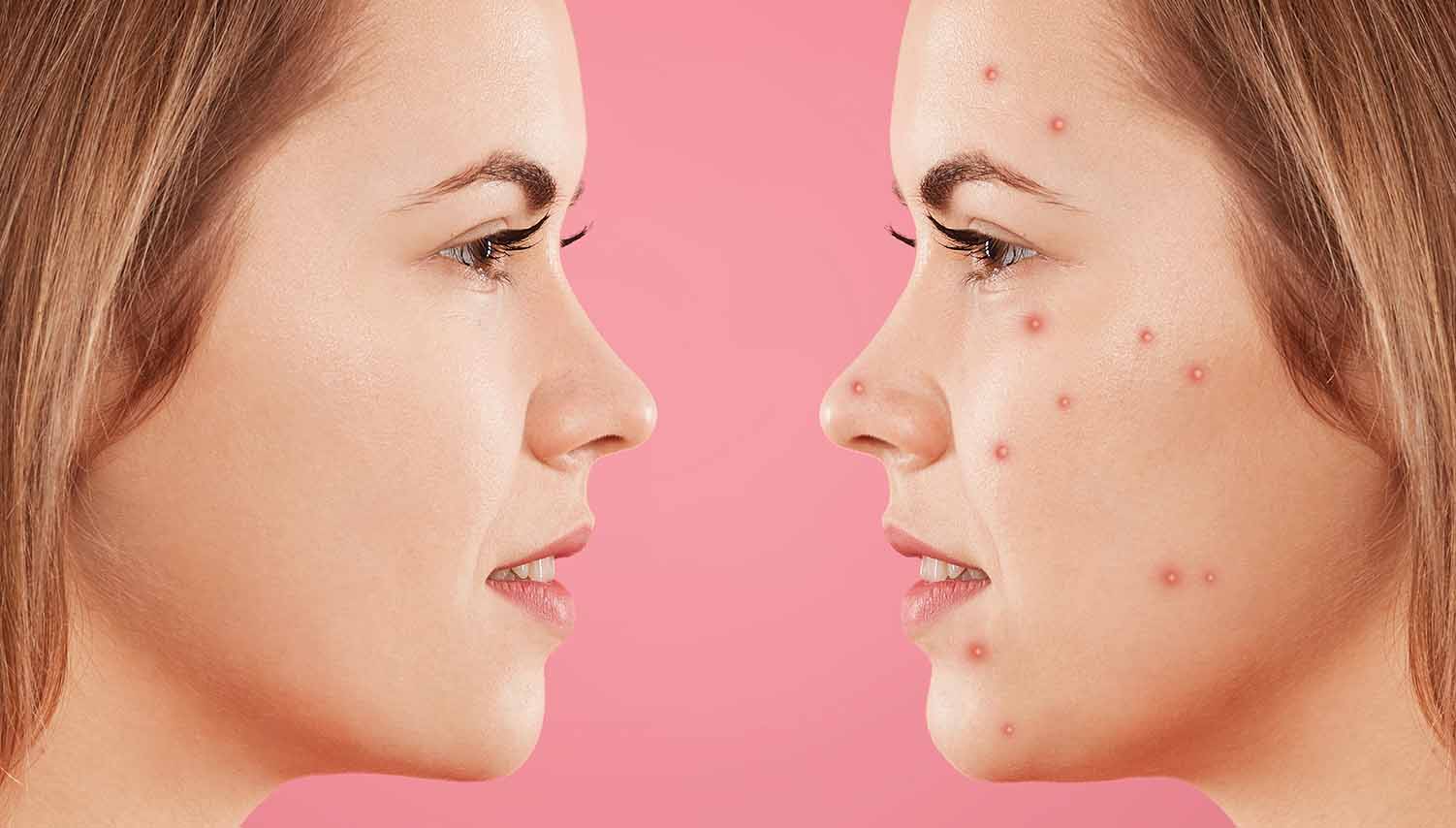 Σπυράκια στο πρόσωπο: Πώς να τα καλύψετε